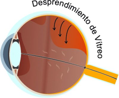 Retina Vitreo Desprendimiento De V Treo Ioba Instituto