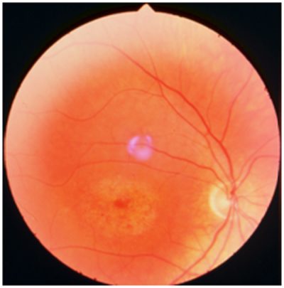 Retina Vitreo Enfermedades Hereditarias De La Retina Distrofias